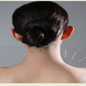 Bild von Acupuncture Right