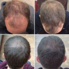 Bild von Capital Hair Restoration