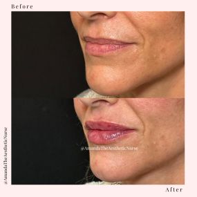 Before and after fillers