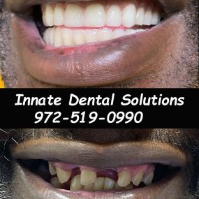 dental implants plano tx