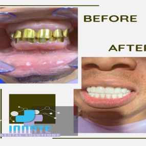dental implants plano tx