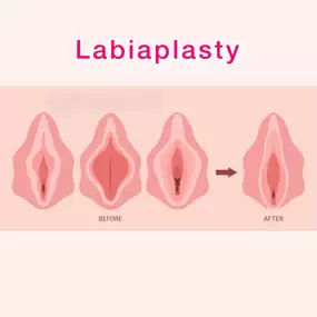 Bild von Labiaplasty London