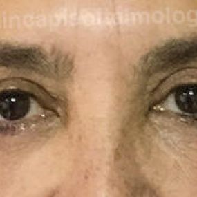 BLEFAROPLASTIA-DE-PARPADO-SUPERIOR-E-INFERIOR-despues-chica.jpg