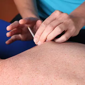 Dry Needling