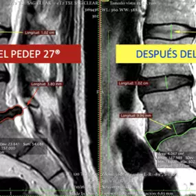 antes-despues-pedep-27.png