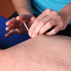 Dry Needling