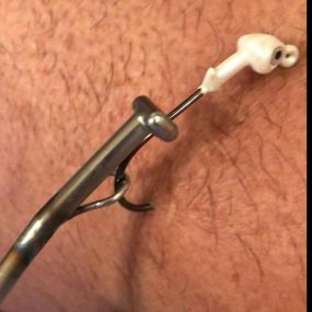 fishing hook in arm and using DHUKR Human Dehooker Tool to remove