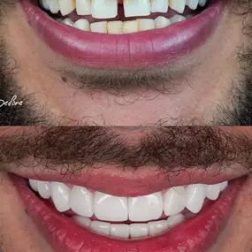 Before and After of Porcelain Veneers
