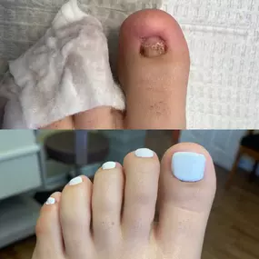 (Top) Before Keryflex treatment, toenail restoration