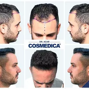 Bild von Cosmedica - Hair Transplant Turkey