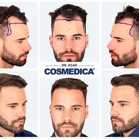 Bild von Cosmedica - Hair Transplant Turkey