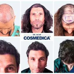 Bild von Cosmedica - Hair Transplant Turkey