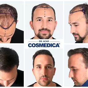 Bild von Cosmedica - Hair Transplant Turkey