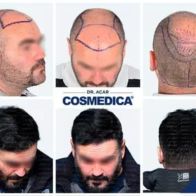 Bild von Cosmedica - Hair Transplant Turkey