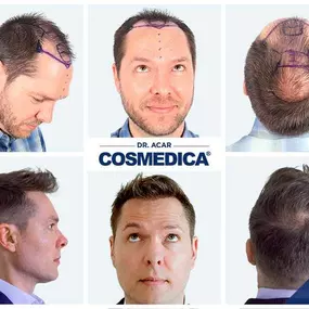 Bild von Cosmedica - Hair Transplant Turkey