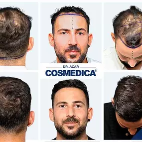 Bild von Cosmedica - Hair Transplant Turkey