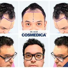 Bild von Cosmedica - Hair Transplant Turkey