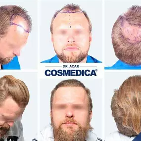 Bild von Cosmedica - Hair Transplant Turkey