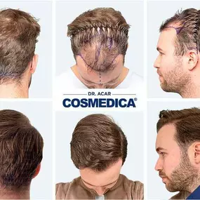 Bild von Cosmedica - Hair Transplant Turkey