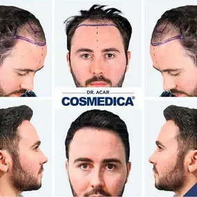 Bild von Cosmedica - Hair Transplant Turkey