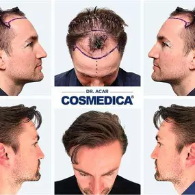 Bild von Cosmedica - Hair Transplant Turkey