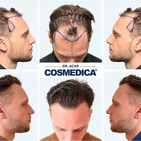 Bild von Cosmedica - Hair Transplant Turkey