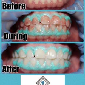 Dental Treatment Result - Kyle Parkway Dentistry