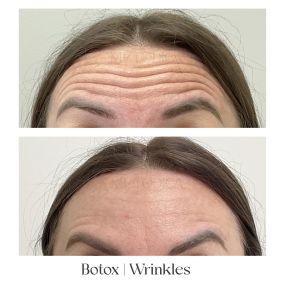 best botox near Brighton Beach Brooklyn