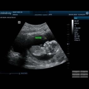 Bild von (Arlington) Baby Bee 3D Ultrasound + Studio