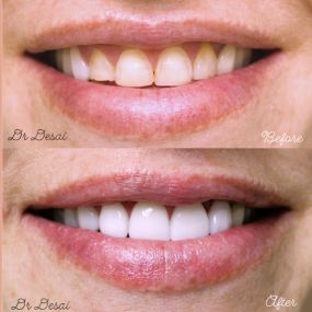 Teeth Whitening - Larwin Square Dentistry Tustin