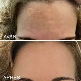 Résultat après peeling