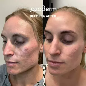 Bild von Lazaderm