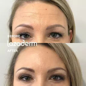 Botox