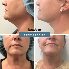Laser Assisted Liposuction