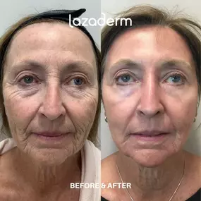 Erbium Resurfacing