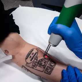 Tattoo Removal at Lazaderm
