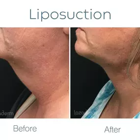 Laser Assisted Liposuction at Lazaderm