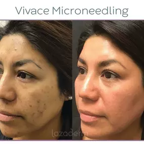 Vivace Microneedling at Lazaderm