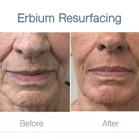Erbium Resurfacing at Lazaderm