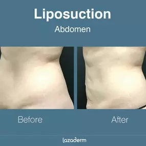 Liposuction at Lazaderm