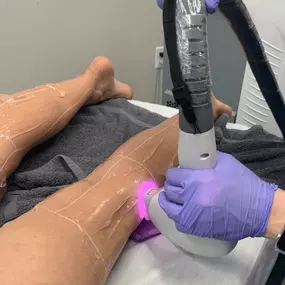 Laser Hair Removal