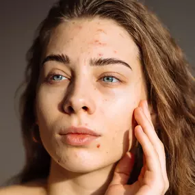 Pure Esthetics Birmingham offers advanced acne scar removal treatments that smooth skin texture, reduce discoloration, and restore confidence. Safe, effective therapies designed to heal damaged skin and reveal a clearer, healthier complexion.
