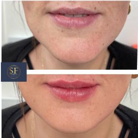 Dermal Filler treatment to lips and chin, using 2mls of high quality dermal filler.