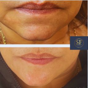 Lower face filler to smooth the jaw and chin area.