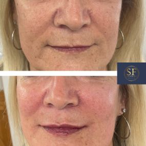 Dermal Filler treatment to lips, cheeks and chin, using 3mls of high quality dermal filler.