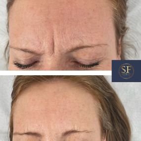 Before and after photo of anti-wrinkle medication injected into the frown lines.