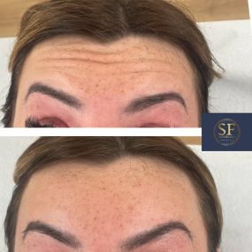 Before and after photo of anti-wrinkle medication injected into the frown lines and forehead lines.