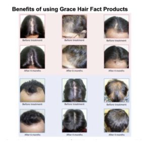 Hair Loss & Restoration Specialists