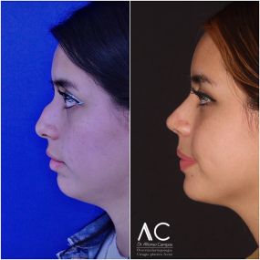 Bild von Dr Alfonso Campos Rinoplastia