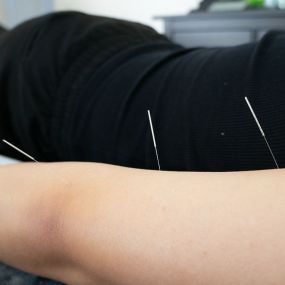 Bild von Pinnacle Acupuncture